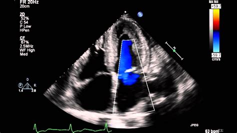 2d echo with cfd